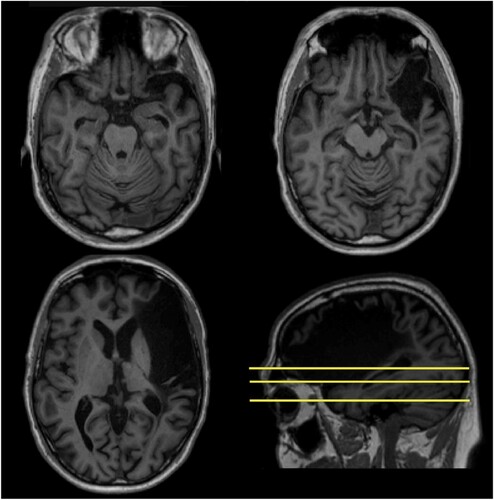 Figure 1. M.T.’s MRI, as of April 17, 2015. A T1-weighted structural 3D scan was obtained using a 3T Siemens MAGNETOM Prisma scanner. Bottom right: The sagittal slice through the right hemisphere shows the location of the three horizontal slices, ordered from top left (ventral) to bottom left (more dorsal).