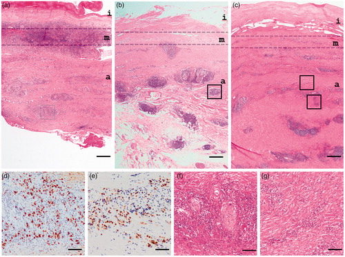 Figure 2. Histopathological findings of IgG4-related abdominal aortic aneurysm. (a) Inflammation with lymphoplasmacytes is observed predominantly in the medial layer. (b) Diffuse inflammation with lymphoid follicles and fibrosis are detected mainly in the adventitia layer that is in part spreading to adjacent adipose tissue. (c) Fibrosis progresses to adjacent adipose tissue. (d,e) Massive infiltration of IgG4-immunopositive cells in adventitia (d and e correspond to box areas of a and b, respectively). (f) Perineural infiltration. (g) storiform fibrosis. A higher magnification of the box area of (c). Original magnifications and scale bar, respectively, are ×12.5 and 500 μm (a–c), ×200 and 50 μm (d, e), and ×100, and 100 μm (f, g). i, intima; m, media; a; adventitia.
