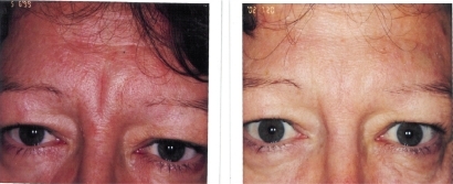 Figure 3 Combination approach: skincare, HA filler, botulinum toxin after three years.