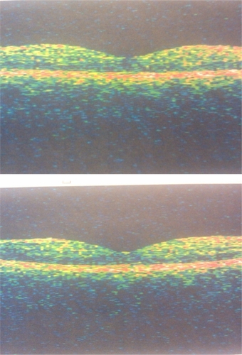 Figure 3 A) Optical coherence tomograph of macula at six weeks following injection, right eye. B) Optical coherence tomograph of macula at six weeks following injection, left eye.