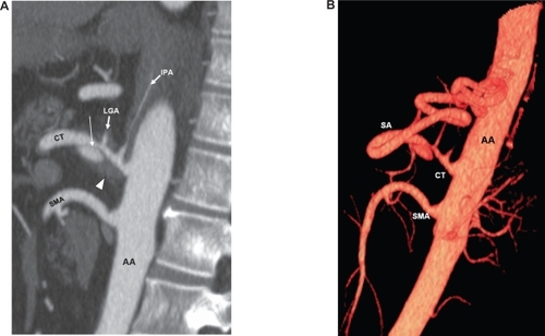 Figure 2 A) Contrast-enhanced sagittal reformatted computed tomography image shows celiac trunk (CT) dissection (arrow) with associated aneurysmal formation and thrombus (arrowhead) involving the false lumen. B) Three-dimensional volume-rendered reformatted image shows narrowing of proximal celiac trunk (CT), which represents true lumen. AA denotes abdominal aorta; IPA denotes inferior phrenic artery; LGA denotes left gastric artery; SMA denotes superior mesenteric artery.