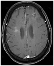 Figure 6. Brain MRI after whole brain radiation therapy. Brain MRI showed a reduction of enhanced lymphoma lesions on post-contrast T1 image after completion of WBRT, at 24 months since diagnosis.WBRT: Whole brain radiation therapy.