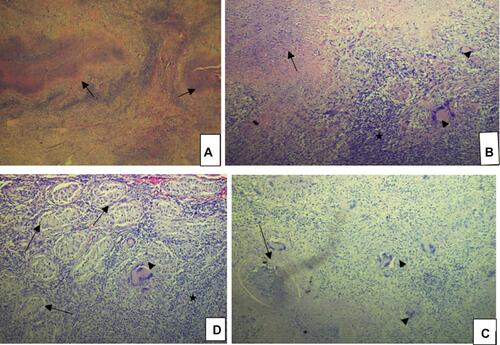 Figure 2 Shows the histology of the left testis (H&E stain). (A) Low power (×5); granulomas (arrows). (B) Low power (×10); caseous necrosis (arrow), numerous inflammatory cells (asterisk) and classic Langhan giant cells (arrowheads). (C) Low power (×10); numerous Langhan giant cells (arrowhead) and granuloma with caseation (arrow). (D) ×20 magnification showing atrophic seminiferous tubules (arrows) with interspersed inflammatory cells (asterisk) and Langhan giant cells (arrowhead).