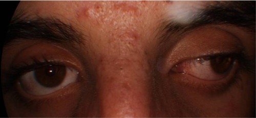 Figure 1 Clinical photograph of the patient showing exotropia in the left eye.