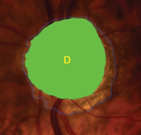 Figure 4 Disc area (D).