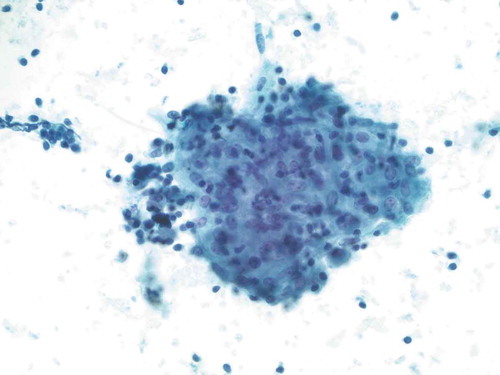 Figure 4. Representative epithelioid cellular cluster showing architectural cohesion, indistinct cytoplasmic borders, and uniform-appearing nuclei with minute nucleoli, consistent with non-caseating granuloma (Papanicolaou stain, 400x original magnification)