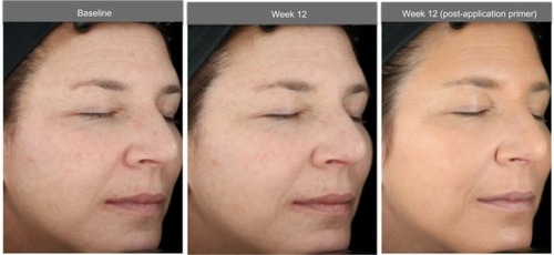 Figure 4 Photographs of a 55-year-old subject with Fitzpatrick skin type II: baseline (left photo) and after 12 weeks of test product (without primer applied [center photo] and with primer applied [right photo]).