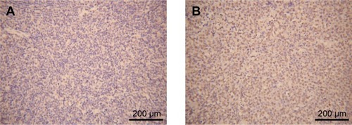 Figure 1 CD40 immunohistochemistry in tissues of DLBCL patients.