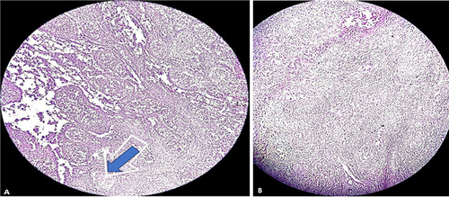 Figure 3 Pictures of the histopathology specimen slides. (A) Low power view showing nodular aggregates of epithelioid histiocytes (granuloma) with focus of necrosis at the center (indicated by the blue arrow). (B) Mononuclear inflammatory cells rimming the histiocytic aggregates.
