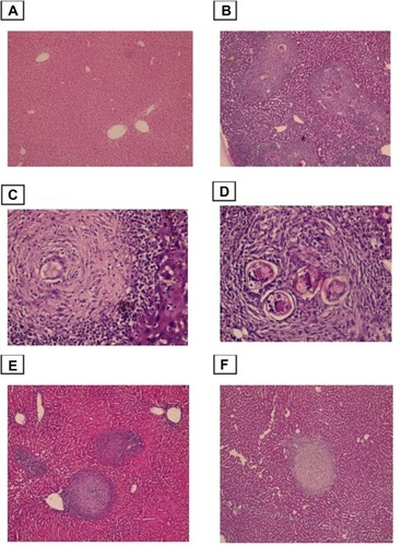 Figure 3 Photomicrographs of the liver stained with H&E.Notes: (A) control group, showing normal portal triad along with a normal hepatocytes and the central vein (×100). (B)Infected untreated group, showing numerous granulomas with bilharzial ova surrounded by numerous chronic inflammatory cells (×100). (C and D) Higher power view showed numerous bilharzial ova containing meracedium and brownish black bilharzial pigmentation(straight arrow) and hydropic degeneration in hepatocytes (curved arrow) (×400). (E) PZQ treated group. (F) Eugenol treated group, showing reduced size and number of granuloma and decreased amount of bilharzial ova and the chronic inflammatory cells with absence of hydropic changes in hepatocytes (×100).