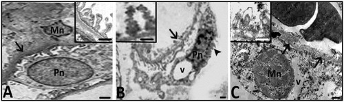 Figure 8. Electron micrographs belonging to the control (A) and Hg (B,C) groups are seen. Mn; nucleus of mesengial cell, Pn; nucleus of podocyte. EM pictures in B and C show that damaged appearance of mesangial cells and podocytes with irregular membrane and nuclear contours (arrow head), hyperchromatic nuclei and also thickened and degenerated basement membrane (arrows and inset in C). Inset in B shows pedicels having irregular boundaries in Hg group. Bars show 0.5 μm.