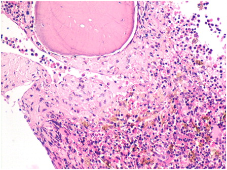Figure 3. Hypercellular bone marrow biopsy shows erythroid hyperplasia with hemosiderin pigment. The paratrabecular area shows pale staining pseudo-Gaucher cells (hematoxylin and eosin, ×400).
