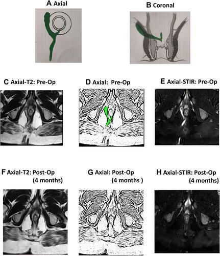 Figure 3 A 32-year-old male patient with a posterior high transsphincteric fistula. MRI done 16 weeks after surgery showed complete healing. He had a weighted score of zero as per the new scoring system (NSS). The patient is asymptomatic after a follow-up of 30 months. (A) Axial section (schematic diagram); (B) Coronal section (schematic diagram); (C) Pre-operative axial T2-weighted MRI showing high tract on right side; (D) Sketch of figure-(C) highlighting high tract on right side (green color); (E) Pre-operative axial STIR MRI; (F) Post-operative axial T2-weighted MRI showing healed fistula at 4 months; (G) Sketch of figure (F); (H) Post-operative axial STIR MRI showing healed fistula. STIR: Short-T1 Inversion Recovery.