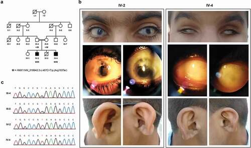 Figure 1. Family structure, clinical and molecular findings: (a) Pedigree showing segregation of the nonsense mutation (M) p(Arg153Ter) in the HMX1 gene. White and black shapes denote healthy and affected individuals, respectively; squares, males; circles, females; symbols with a diagonal line, deceased; double horizontal lines, consanguineous union. (b) Photographs of eyes and ears of the individuals examined (IV-2 and IV-4). (c) Chromatograms showing segregation of p(Arg153Ter) within the family.