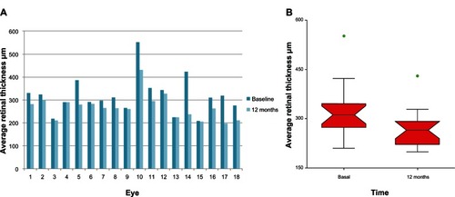 Figure 2 (A) Effect of the curcumin-lecithin formulation (Norflo®) on OCT retinal thickness after 12 months of treatment (B) The notched box plot displays the confidence interval around the median which is normally based on the median ± 1.57 × interquartile range/square root of n. According to the graphical methods for data analysis, if two boxes’ notches do not overlap there is ‘strong evidence’ (95% confidence) that their medians differ. Points outside the whisker boundaries are considered outliers (green = mild).