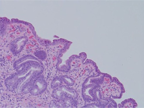 Figure 2 Human gastric biopsy showing lymphocytic infiltrate.