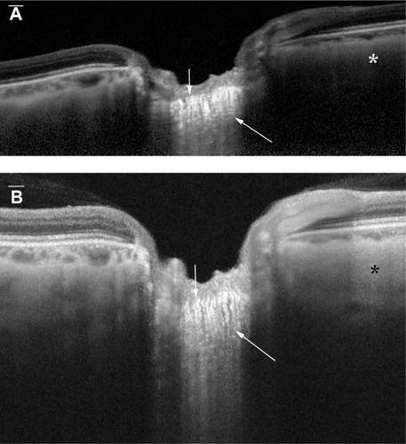 Figure 1 (A) Vertical EDI OCT and (B) HP-OCT images of the deep optic nerve head and deep peripapillary structures.