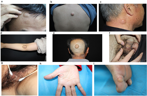 Figure 5 Typical lesions in different sites. (A) Scalp. (B) Face. (C) Neck. (D) Trunk. (E) upper limb. (F) Palm of hand (G) Ventral of penis. (H) Great lips of pudendum. (I) Sole of foot.