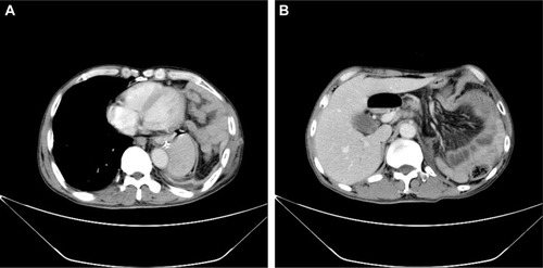 Figure 1 (A) A transverse computed tomography scan of the patient’s chest on admission showing a large left-sided diaphragmatic hernia with bowel loops herniating into the left side of the chest, causing a mediastinal shift and resulting in small-bowel obstruction. (B) Axial CT of the abdomen showed intraperitoneal mesenteric folds.