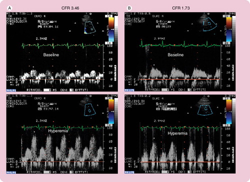 Figure 1. Normal (A) and pathological (B) coronary flow velocity reserve signal.*Indicates the diastolic velocity in Doppler signal.