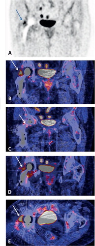 Figure 2. Example of 18F-FDG uptake in a non-infected total hip prosthesis. (A) Coronal FDG-PET image showing FDG uptake around the prosthesis, most prominent at the lateral side of the collum; (B, C, D) Coronal fused FDG-PET/CT images at different slices showing the uptake around the prosthesis; (E) Transaxial fused FDG-PET/CT image showing prominent physiological uptake at the lateral side of the cup of the prosthesis.