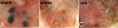 Figure 2 Dermoscopic examination results in our 82-year-old male patient. (A) The black region shows black globules without a pigment network against a red background. (B) The white region shows a scar-like depigmentation area. (C) The red region shows a homogeneous red background.