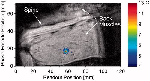 Figure 4. Magnitude image in coronal slice at time of maximum heating with temperature change overlay. The animal is supine, slightly oblique, with the head to the right of the image, and the field of view has been truncated to show only the region of interest, including the spine and back muscles. The threshold for temperature display is 2 °C.