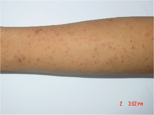 Figure 5. Actinic folliculitis.