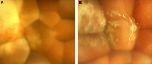 Figure 3 Fundus photographs of the right eye.