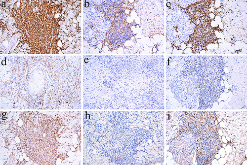 Figure 3 Immunohistochemical images of case 3. (a) (200X) CD3 was strongly positive expression. (b) (200X) CD4 was mild positive expression. (c) (200X) CD8 was strongly positive expression. (d) (200X) CD20 was scattered positive expression. (e) (200X) CD56 was negative expression. (f) (200X) TIA-1 was positive expression. (g) (200X) TCRβF1 was strongly positive expression. (h) (200X) TCRδ was negative expression. (i) (200X) The positive expression of Ki67 was 30%.