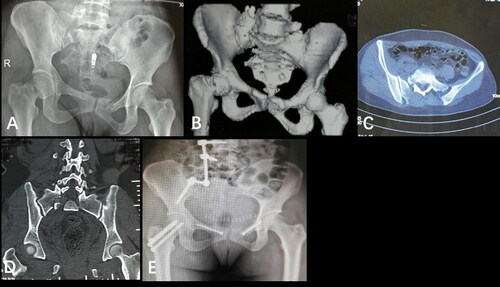 Figure 2. A male patient of zone II sacral fracture fixed with lumbopelvic technique was presented. (A) Preoperative anteroposterior X-ray of pelvis. (B) Preoperative three-dimensional reconstruction. (C, D) Preoperative CT scans. (E) Postoperative anteroposterior X-ray of pelvis.