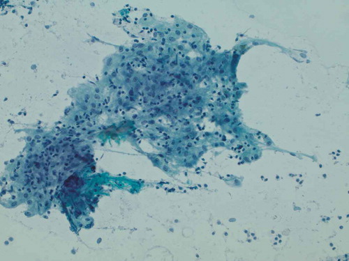 Figure 3. Smear preparation showing cohesive clusters of epithelioid cells, scattered background small lymphocytes (Papanicolaou stain, 200x original magnification)