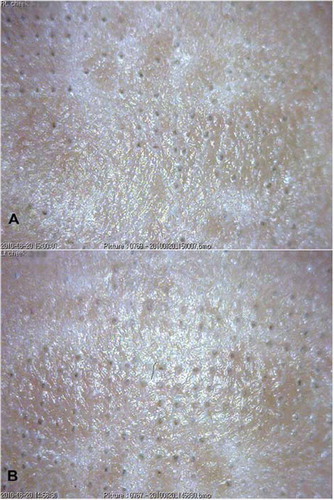 Figure 1. Patient number 6. (A) Side of the face with growth factor application. The microcrust count was 90 as assessed by digital microscope evaluation (per 1.6 × 1.2 cm2; original magnification × 22). (B) Side of the face with normal saline application. The microcrust count was 115. The photography was performed symmetrically on both sides 2 cm down from the lateral margin of the eyes.