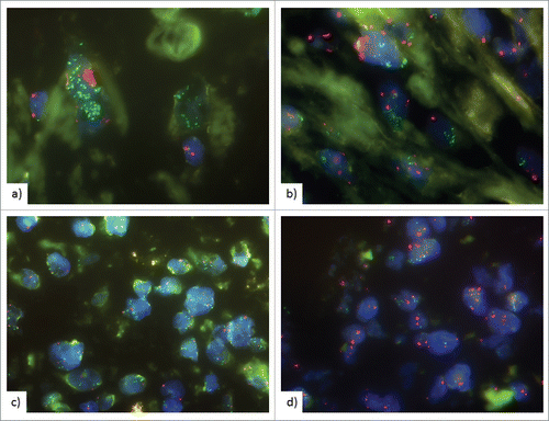 Figure 4. Fluorescence in situ hybridization (FISH) of PD-L1 gene locus. CD274/PD-L1 gene is labelled in green, centromer 9 in red. FISH analysis showing (a), (b) high level amplification with clusters of >15 PD-L1 signals in >10% of tumor nuclei, (c) high level amplification with PD-L1/CEP9 ratio ≥2.0 (d) Low-level amplification with clusters of >5 PD-L1 signals in >50% of tumor nuclei.