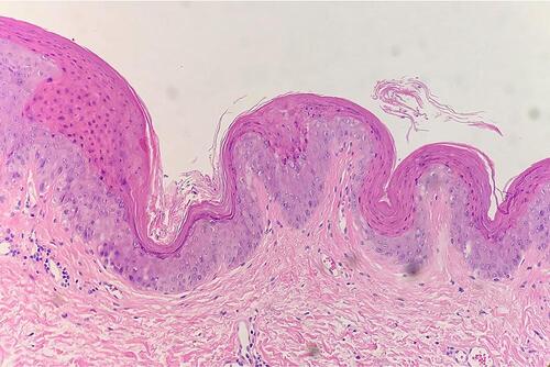 Figure 2 The histopathological finding of GP. Histological changes are mainly located in the stratum corneum of the epidermis. It reveals hyperkeratosis, parakeratosis, numerous transparent keratin granules in the stratum corneum (H&E staining, ×200).
