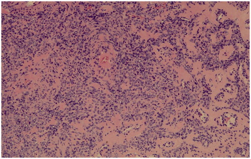 Figure 3. The tumor cells are strongly positive for smooth muscle actin (SMA immunostain, original magnification ×10).