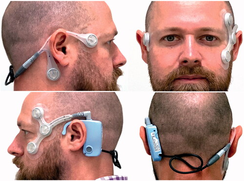 Figure 1. The appearance of the CAVA® device when worn on the head. The device includes a reusable logging module and two, single-use electrode mounts. Five ECG electrodes are placed at specific sites on the face to record the corneo-retinal potential produced by the eyes. A button on the logging unit allows the patient to activate the device’s event marker, which causes the device to log the date and time of the button press. The button can also be used to initiate a status check of the device, the results of which are confirmed visually by the device’s status LED. The status checking feature provides feedback regarding battery level, the connection of the device’s electrodes, and confirmation of event marker activation.