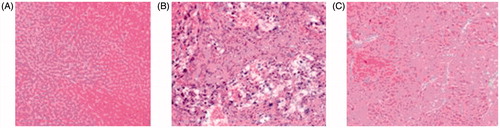 Figure 9. Anticancer activity in vivo. Compound 5i against pathological changes (HE staining ×200). (A). Control (B). DEN Model (C). Compound 5iaaAnimals were randomly divided into 3 groups (n = 12 per group).