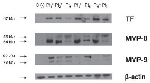 Figure 5 Representative Western blot showing TF protein levels (47 kDa), pro- and active MMP-8 (85 and 64 kDa, respectively) and pro- and active MMP-9 (92 and 78 kDa, respectively) in CEA plaques from diabetic (Pt1*, Pt2*, Pt4*, and Pt6*) and nondiabetic (Pt3, Pt5, and Pt7) patients. Ponceau staining of the membranes (not shown) and beta-smooth muscle actin (β-SMA) were used as loading controls. C (−) is a negative control, blots were incubated without primary antibodies to TF, MMP-8, and MMP-9.