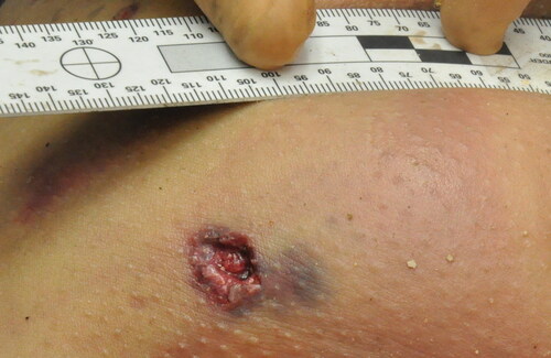 Figure 6. shrapnel-like injury isolated on the body.