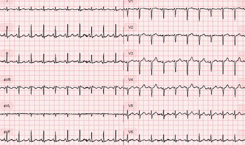 Figure 1. Initial ECG with electric alternans.