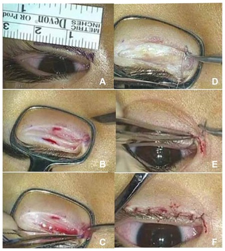 Figure 2 The sequential intraoperative photographs. (A) Marking design: the fish body is designed along the lower eyelid 2 mm beneath the cilia. Its width is about 1 mm and length is 18 mm. The fish tail is a 2 mm triangle, which is designed on the epicanthus fold along the curvature. (B) Fish-body cutting: an eyelid pincher is used to avoid bleeding and to extend the skin. A sharp knife is needed to cut the skin precisely, taking care to cut all the dermis layer along the marking. Just under the skin, orbicularis appear. (C) Fish-tail cutting: at the moment that the triangular fish-tail flap is cut, the tension of orbicularis along the epicanthus disappears. The narrow medial epicanthus angle is released. (D) Hotz mattress suture: mattress sutures are used to connect the tarsus to the dermis. In most cases, four or five stitches are tied to reposition the cilia from an inverted position to a correct orientation. (E) Medial key suture: finally, the residual medial edge is sutured to the corner of the edge of the epicanthus. This one suture opens the medial angle. (F) Appearance just after surgery: after all the skin sutures are done, an L-shaped suture line appears.