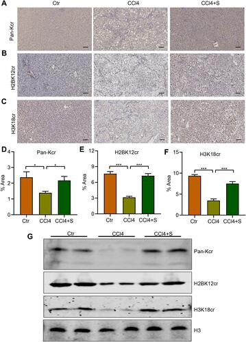 Figure 5 Sorafenib increased protein lysine crotonylation of fibrotic liver in CCl4-induced rats. (A) The levels of total lysine crotonylation (Pan-Kcr) in fibrotic livers. (B) The levels of crotonylated H2BK12 (H2BK12cr) in fibrotic livers. (C) The levels of crotonylated H3K18 (H3K18cr) in fibrotic livers. (D) Semi-quantitative analysis of Pan-Kcr IHC-positive staining areas. (E) Semi-quantitative analysis of H2BK12cr IHC-positive staining areas. (F) Semi-quantitative analysis of H3K18cr IHC-positive staining areas. (G) Western blotting was used to detect the expression of protein lysine crotonylation (Pan-Kcr, H2BK12cr, and H3K18cr). *P<0.05, ***P<0.001.