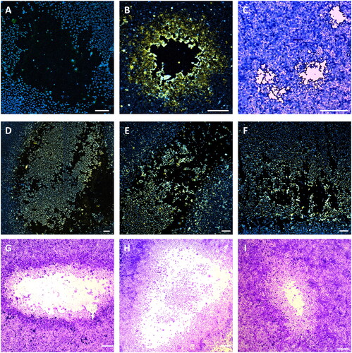 Figure 2. Active SARS-CoV-2 viral particles in patient cough aerosols. Patient cough samples were serial diluted and used to infect Vero E6 cells to isolate active viral particles. Infected Vero E6 were stained for SARS-CoV-2 nucleocapsid protein 1 (N1, yellow) and for nucleic acid (Hoechst, blue), and then analyzed by confocal microscopy. Representative immunofluorescence images of SARS-CoV-2negative PFU (A) and SARS-CoV-2+ PFUs (D–F) obtained from cough samples, as well as lab strain SARS-CoV-2 PFU as control (B). The same plates were then stained with 1% Crystal Violet and images were taken for PFU morphology comparison. Representative brightfield images of SARS-CoV-2+ PFU (G–I) obtained from cough samples, as well as lab strain SARS-CoV-2 PFU as control (C). Scale bar = 200 µm.