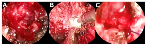 Figure 2 Endoscopic intraoperative images showing the erosion of the sphenoid bone by the tumor (A), the drilling of the apparently healthy bone near the carotid region (B), and the microcottonoid adhering to the artery fissuration (C).