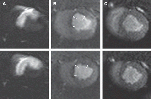 Figure 4. A. The area at risk for microinfarcts demonstrated on LGE shortly after intra-arterial injection of diluted Gd-DOTA. First-pass perfusion images at one hour (B) and 7–8 weeks (C) in two short-axis planes. The area with microinfarcts can be visualized as a perfusion defect (arrows) at one hour but not 7–8 weeks after microembolization.
