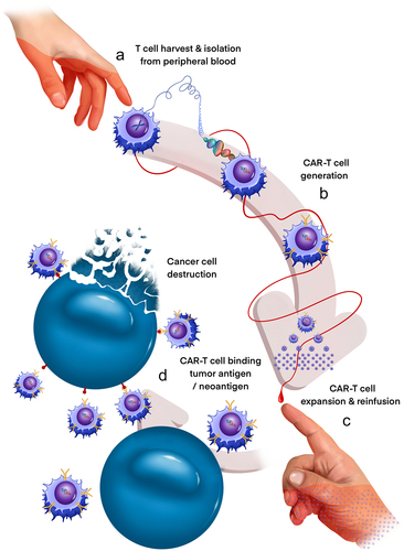 Figure 2. Generation of CAR-T cells for anti-DMG therapy. CAR-T cells present a powerful new approach to precision immunotherapy in DMG. CAR-T cells are generated from a DMG patient’s own T cells (a) and directed against tumor-specific antigens/neoantigens by genetic introduction of a chimeric antigen receptor (CAR) gene (b). Clonally expanded CAR T cells (c) are then reinfused into the originating patient and are activated to promote enhanced tumor cell-specific destruction (d). Treatment of 4 DMG patients with GD2-directed CAR-T cells recently demonstrated both radiologic and clinical benefit, evidencing the transformative potential of this novel therapy.