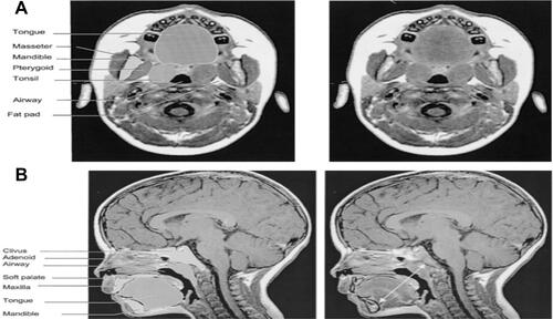 Figure S3 (A) T1-weighted axial image at the retropalated level (right) and segmented regions of interest (left) of a control subject. (B) Midsagittal T1-weighted image with mental spine-clivus distance shown (right) and segmented regions of interest (left) of a control subject.Note: Reprinted with permission of the American Thoracic Society. Copyright © 2020 American Thoracic Society. Uong EC, McDonough JM, Tayag-Kier CE, Zhao H, Haselgrove J, Mahboubi S, et al. 2001. Magnetic resonance imaging of the upper airway in children with Down syndrome. Am J Respir Crit Care Med. 163. 731–736. Official journal of the American Thoracic Society.Citation73