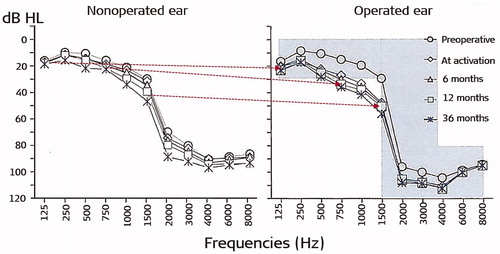 Figure 59. Average pre-op and post-op air conduction hearing thresholds for operated and non-operated ear [Citation62]. Reproduced by permission of Karger AG, Basel.