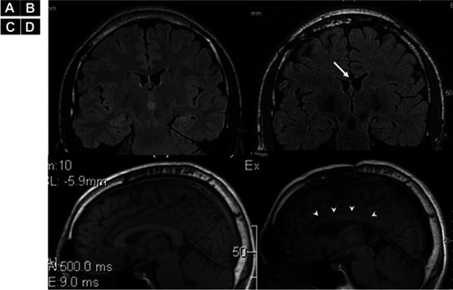 Figure 2 MRI pre- and post-corpus callosotomy for Patient 1. Preoperative coronal (A), sagittal (B), postoperative coronal (C) and sagittal (D) MRI FLAIR of Patient 1.fi. The arrows show that the corpus callosum is totally removed (B and D).